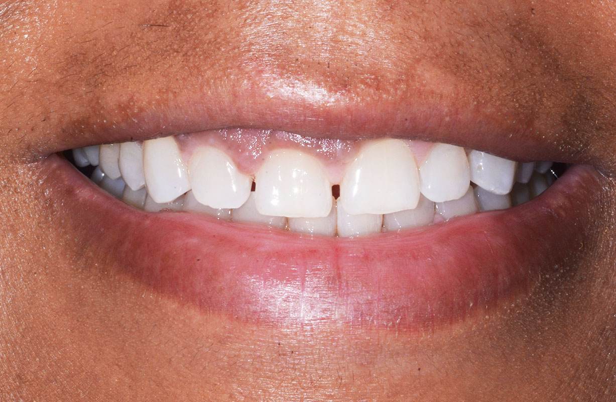 Bioclear Diastema Closure - Clark Dental